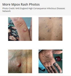 more-example-mpox